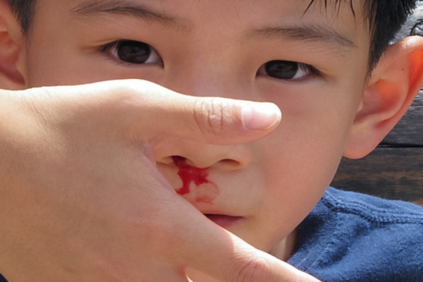Có nên cho trẻ ngả đầu về sau khi chảy máu cam không?